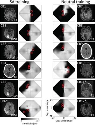 Benefits of Endogenous Spatial Attention During Visual Double-Training in Cortically-Blinded Fields